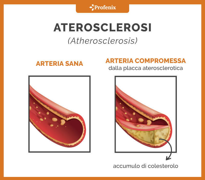 Aterosclerosi Arterie Colesterolo Alto